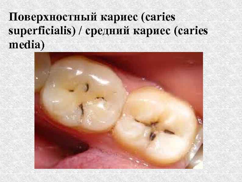 Поверхностный кариес (caries superficialis) / средний кариес (caries media) 