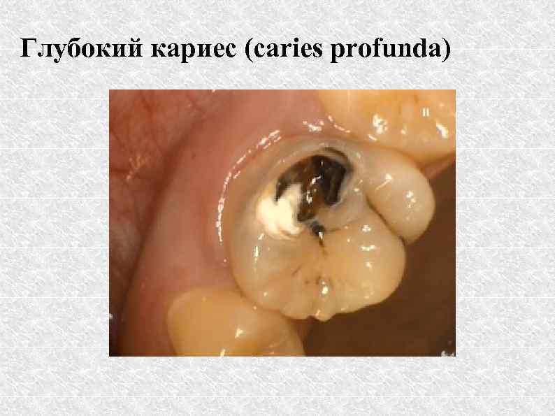 Глубокий кариес (caries profunda) 