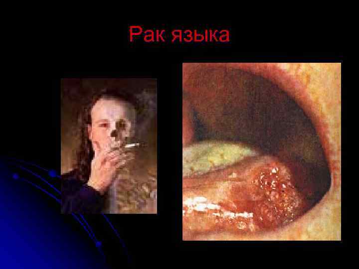 Рак языка 