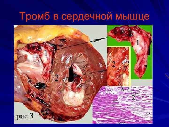 Тромб в сердечной мышце 