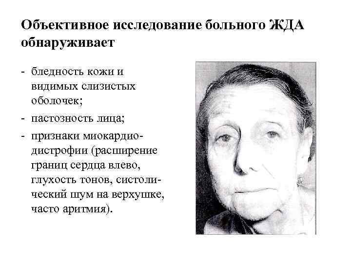 Объективное исследование больного ЖДА обнаруживает - бледность кожи и видимых слизистых оболочек; - пастозность