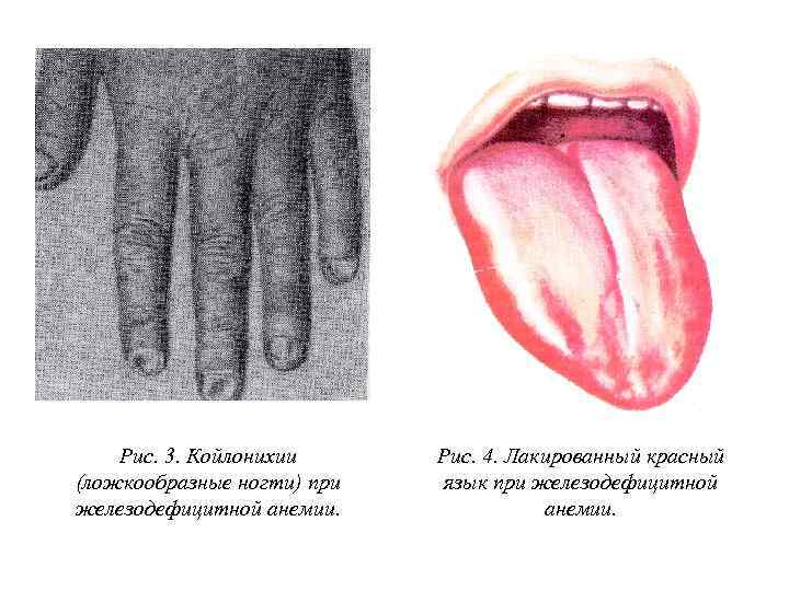Рис. 3. Койлонихии (ложкообразные ногти) при железодефицитной анемии. Рис. 4. Лакированный красный язык при