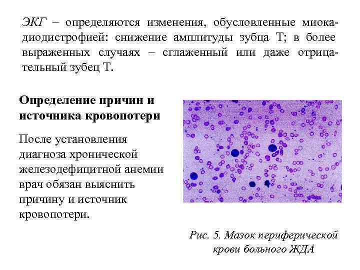 ЭКГ – определяются изменения, обусловленные миокадиодистрофией: снижение амплитуды зубца Т; в более выраженных случаях