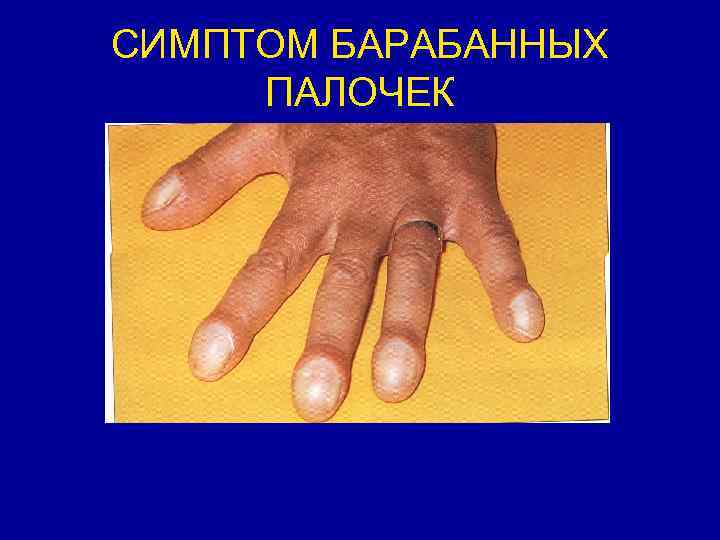 СИМПТОМ БАРАБАННЫХ ПАЛОЧЕК 