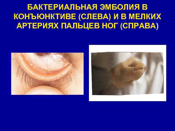 БАКТЕРИАЛЬНАЯ ЭМБОЛИЯ В КОНЪЮНКТИВЕ (СЛЕВА) И В МЕЛКИХ АРТЕРИЯХ ПАЛЬЦЕВ НОГ (СПРАВА) 