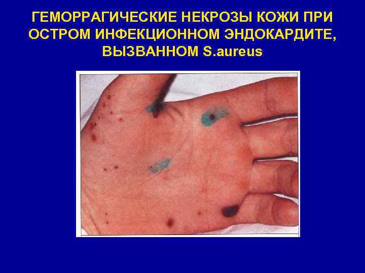 ГЕМОРРАГИЧЕСКИЕ НЕКРОЗЫ КОЖИ ПРИ ОСТРОМ ИНФЕКЦИОННОМ ЭНДОКАРДИТЕ, ВЫЗВАННОМ S. aureus 