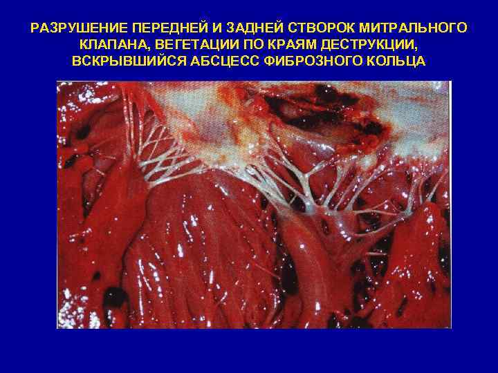 РАЗРУШЕНИЕ ПЕРЕДНЕЙ И ЗАДНЕЙ СТВОРОК МИТРАЛЬНОГО КЛАПАНА, ВЕГЕТАЦИИ ПО КРАЯМ ДЕСТРУКЦИИ, ВСКРЫВШИЙСЯ АБСЦЕСС ФИБРОЗНОГО