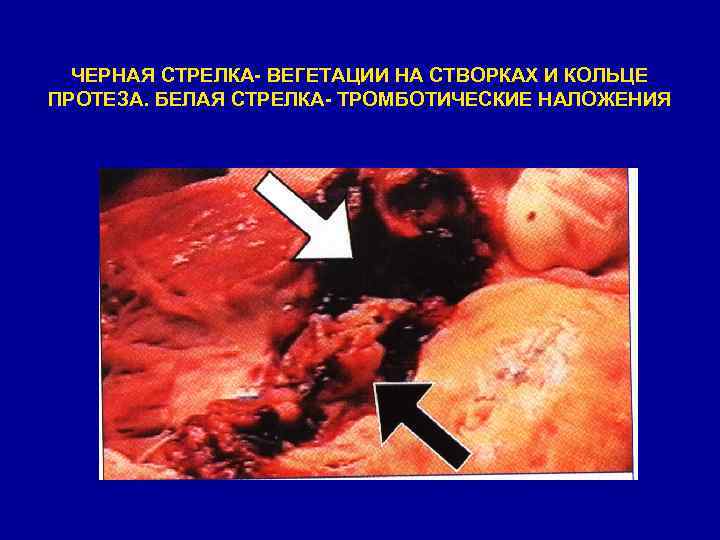 ЧЕРНАЯ СТРЕЛКА- ВЕГЕТАЦИИ НА СТВОРКАХ И КОЛЬЦЕ ПРОТЕЗА. БЕЛАЯ СТРЕЛКА- ТРОМБОТИЧЕСКИЕ НАЛОЖЕНИЯ 