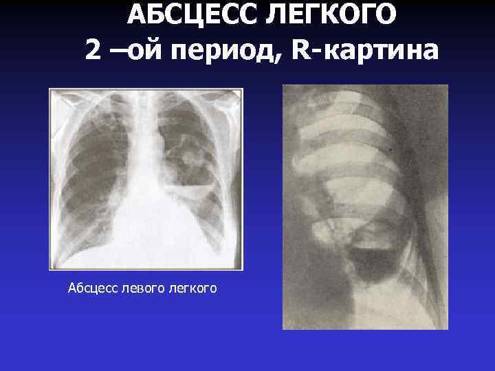 АБСЦЕСС ЛЕГКОГО 2 –ой период, R-картина Абсцесс левого легкого 