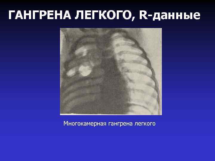 ГАНГРЕНА ЛЕГКОГО, R-данные Многокамерная гангрена легкого 