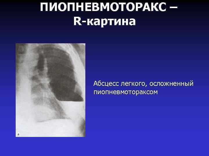 ПИОПНЕВМОТОРАКС – R-картина Абсцесс легкого, осложненный пиопневмотораксом 