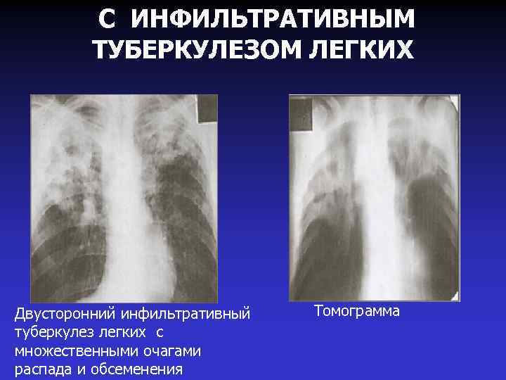 С ИНФИЛЬТРАТИВНЫМ ТУБЕРКУЛЕЗОМ ЛЕГКИХ Двусторонний инфильтративный туберкулез легких с множественными очагами распада и обсеменения