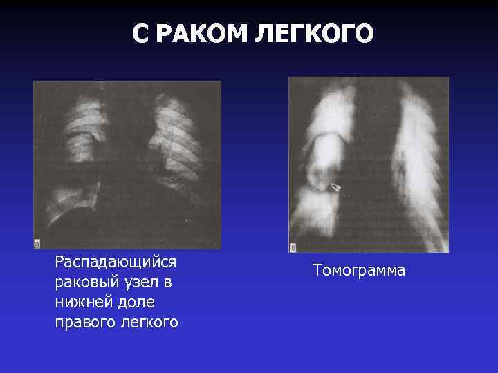 С РАКОМ ЛЕГКОГО Распадающийся раковый узел в нижней доле правого легкого Томограмма 