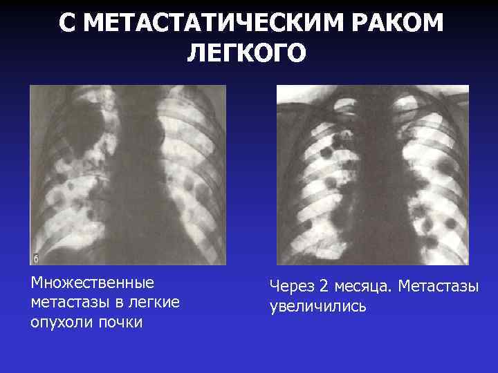 С МЕТАСТАТИЧЕСКИМ РАКОМ ЛЕГКОГО Множественные метастазы в легкие опухоли почки Через 2 месяца. Метастазы