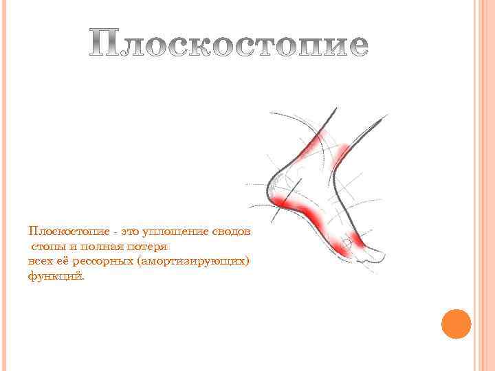 Плоскостопие - это уплощение сводов стопы и полная потеря всех её рессорных (амортизирующих) функций.