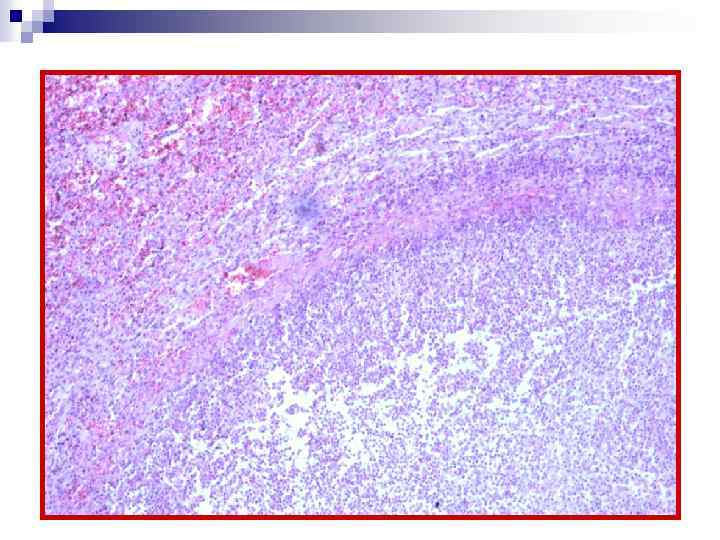 Абсцесс (пиогендік мембрана) Абсцесс (пиогенная мембрана) 