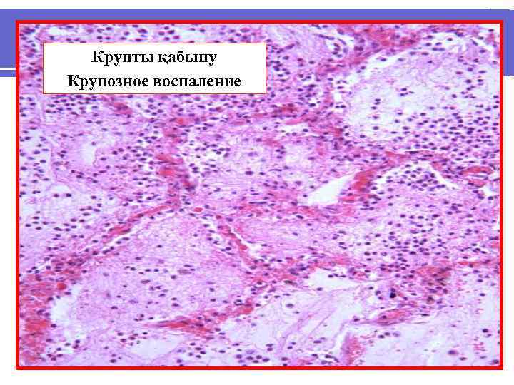 Крупты қабыну Крупозное воспаление 