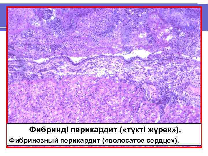 Фибринді перикардит ( «түкті жүрек» ). Фибринозный перикардит ( «волосатое сердце» ). 