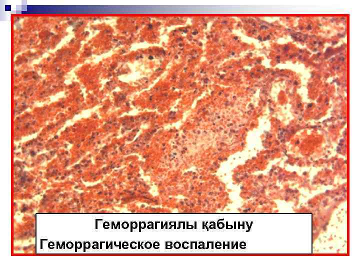 Геморрагиялы қабыну Геморрагическое воспаление 