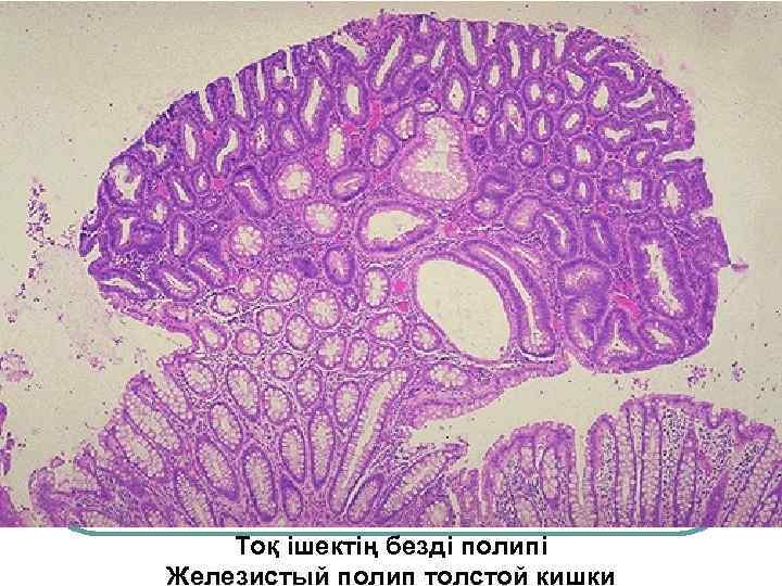 Тоқ ішектің безді полипі Железистый полип толстой кишки 