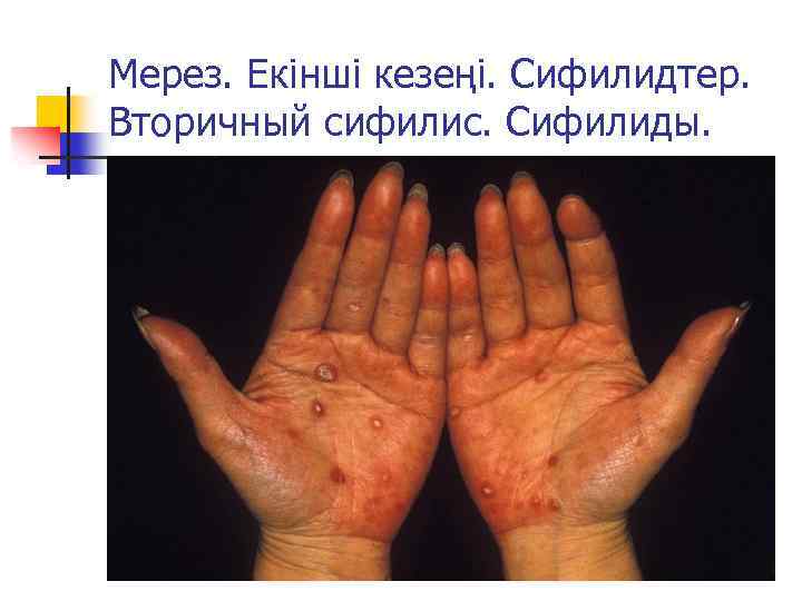 Мерез. Екінші кезеңі. Сифилидтер. Вторичный сифилис. Сифилиды. 