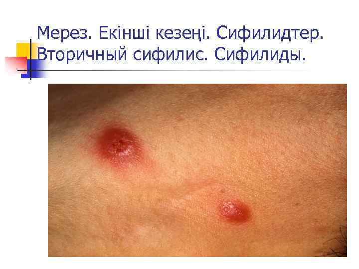 Мерез. Екінші кезеңі. Сифилидтер. Вторичный сифилис. Сифилиды. 