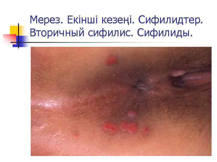 Мерез. Екінші кезеңі. Сифилидтер. Вторичный сифилис. Сифилиды. 