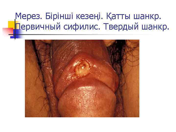 Мерез. Бірінші кезеңі. Қатты шанкр. Первичный сифилис. Твердый шанкр. 