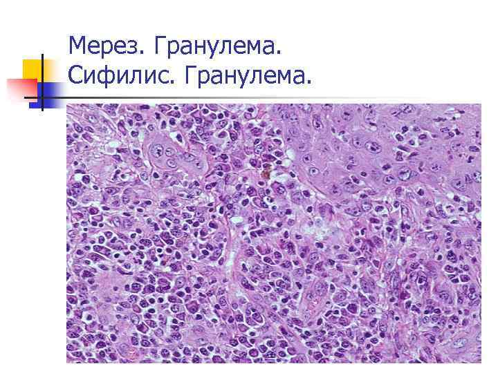 Мерез. Гранулема. Сифилис. Гранулема. 