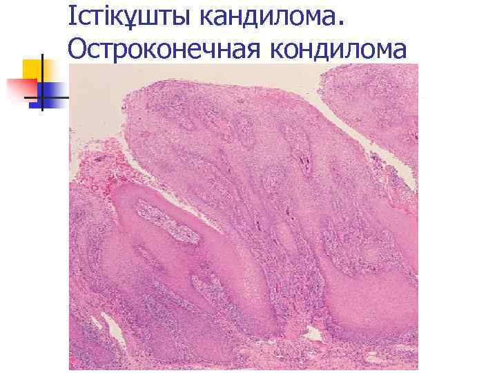 Істікұшты кандилома. Остроконечная кондилома 