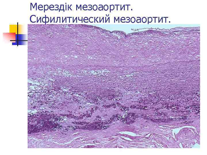 Мерездік мезоаортит. Сифилитический мезоаортит. 