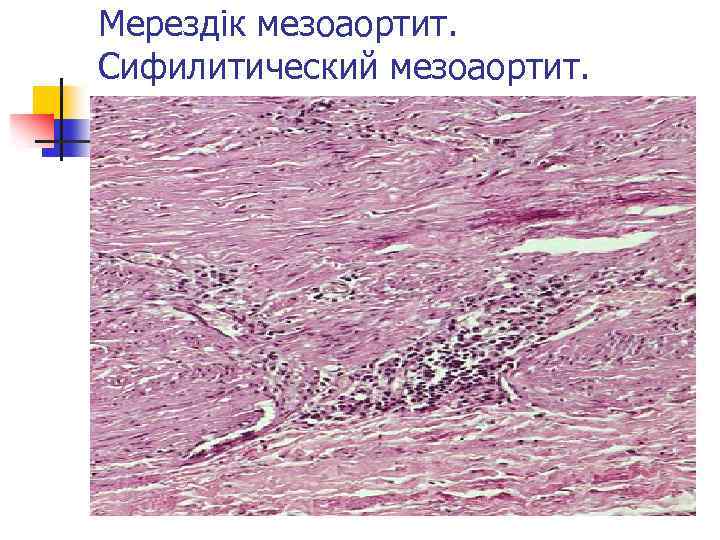 Мерездік мезоаортит. Сифилитический мезоаортит. 