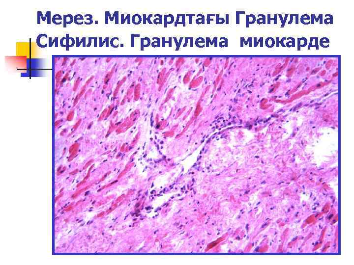 Мерез ауруы презентация