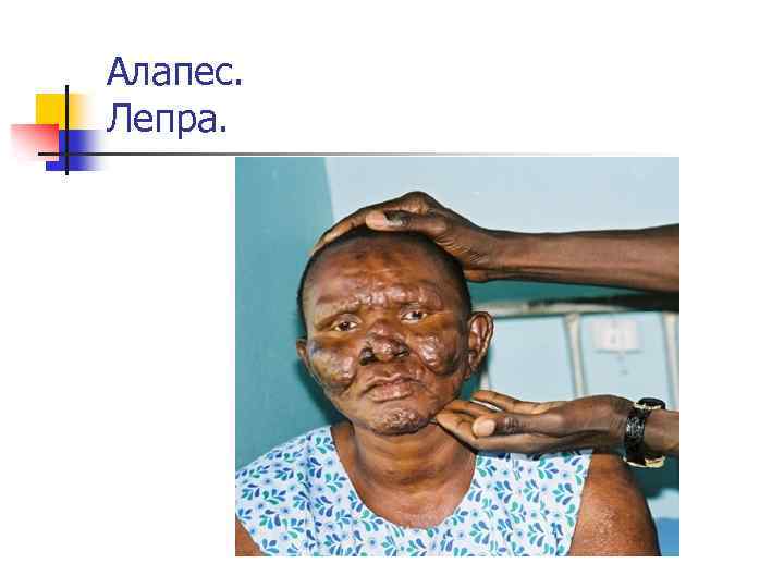 Алапес. Лепра. 