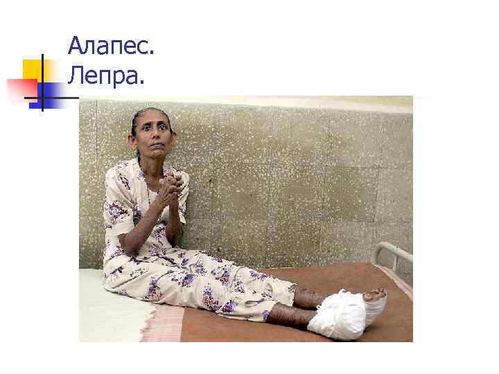 Алапес. Лепра. 