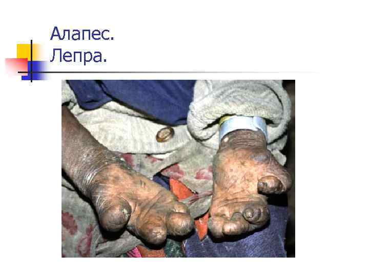 Алапес. Лепра. 