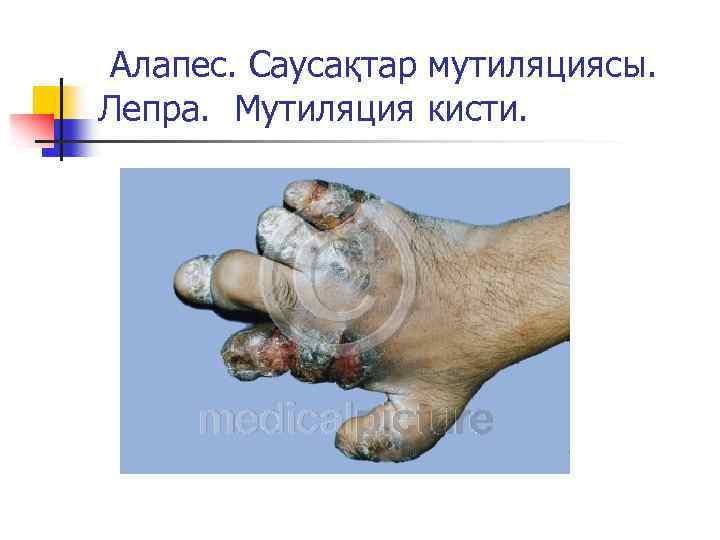 Алапес. Саусақтар мутиляциясы. Лепра. Мутиляция кисти. 