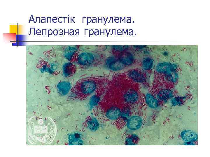 Алапестік гранулема. Лепрозная гранулема. 