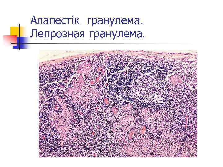 Алапестік гранулема. Лепрозная гранулема. 