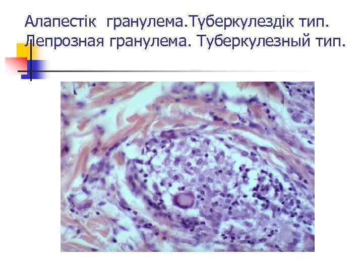 Алапестік гранулема. Түберкулездік тип. Лепрозная гранулема. Туберкулезный тип. 