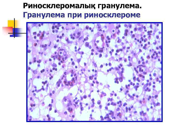 Риносклеромалық гранулема. Гранулема при риносклероме 