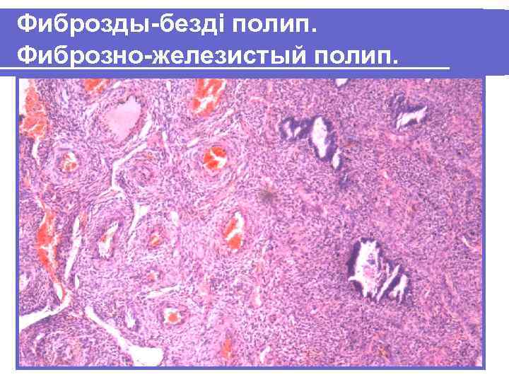 Фиброзды-безді полип. Фиброзно-железистый полип. 