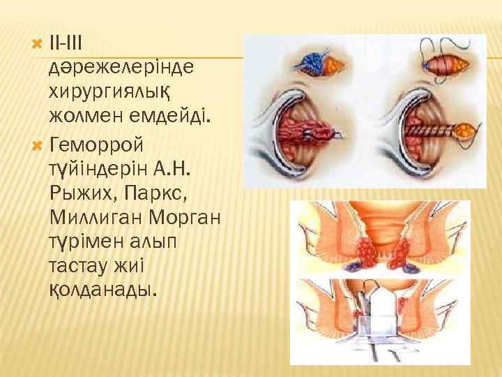  II-III дәрежелерінде хирургиялық жолмен емдейді. Геморрой түйіндерін А. Н. Рыжих, Паркс, Миллиган Морган