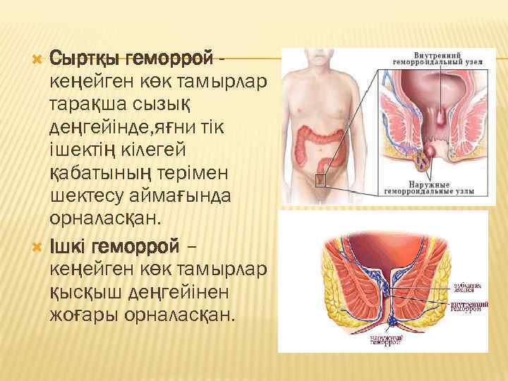 Сыртқы геморрой кеңейген көк тамырлар тарақша сызық деңгейінде, яғни тік ішектің кілегей қабатының терімен