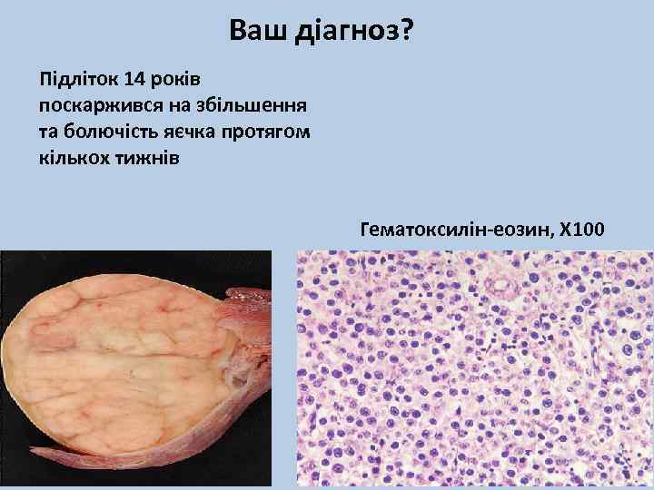 Ваш діагноз? Підліток 14 років поскаржився на збільшення та болючість яєчка протягом кількох тижнів