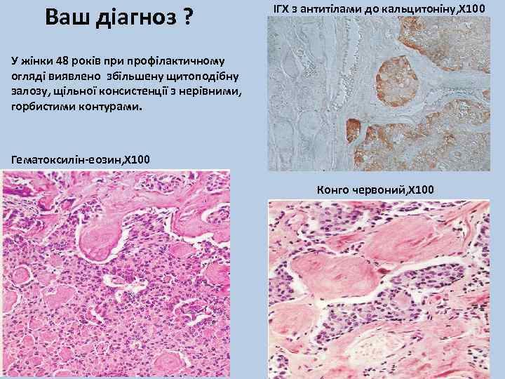 Ваш діагноз ? ІГХ з антитілами до кальцитоніну, Х 100 У жінки 48 років