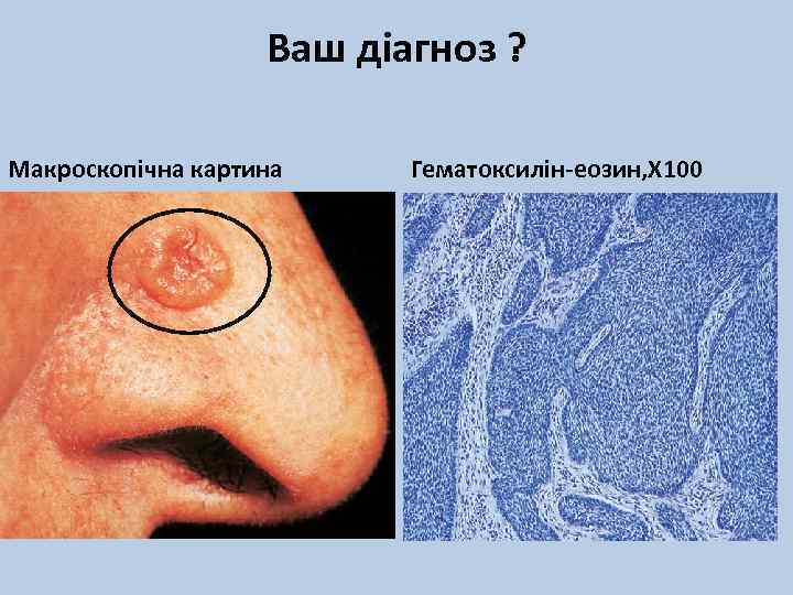 Ваш діагноз ? Макроскопічна картина Гематоксилін-еозин, Х 100 
