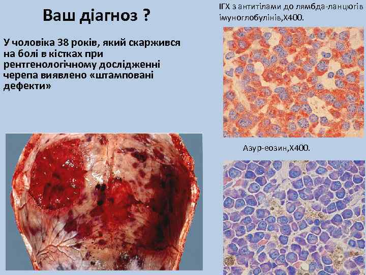 Ваш діагноз ? ІГХ з антитілами до лямбда-ланцюгів імуноглобулінів, Х 400. У чоловіка 38