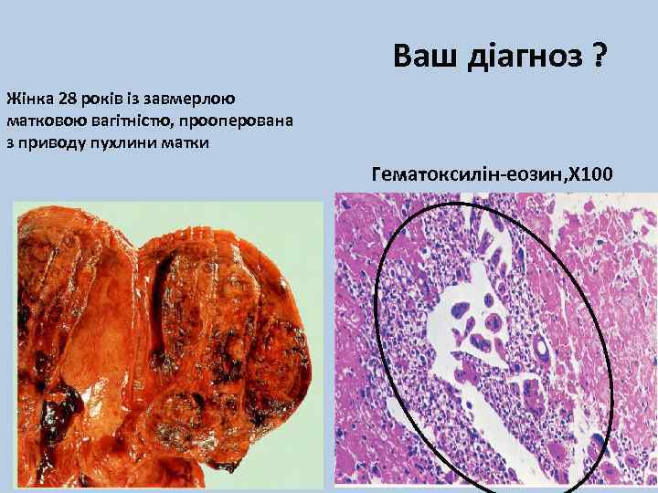 Ваш діагноз ? Жінка 28 років із завмерлою матковою вагітністю, прооперована з приводу пухлини