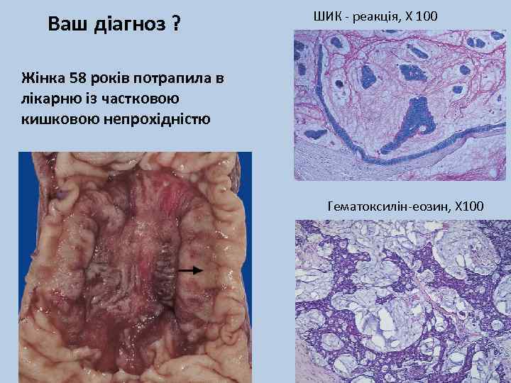 Ваш діагноз ? ШИК - реакція, Х 100 Жінка 58 років потрапила в лікарню